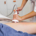 Radiofrecuencia fraccionada corporal