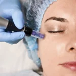 Plan facial con Microneedling